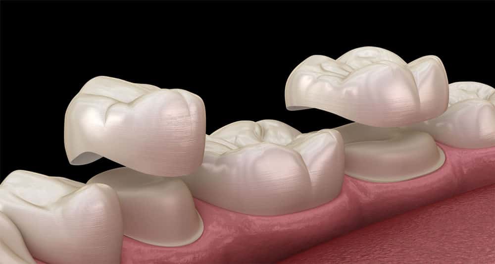 Porcelain veneers are a method of restoring teeth to overcome many tooth conditions