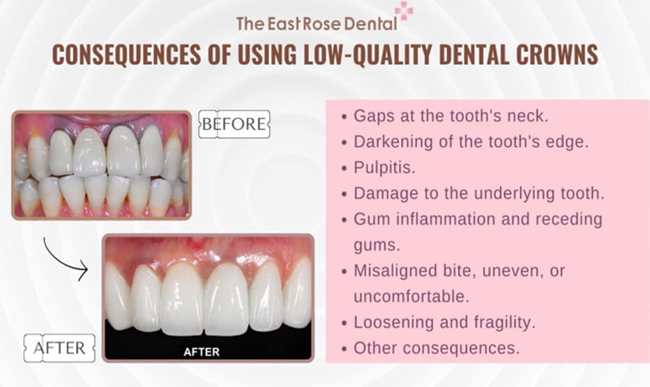 Consequences of using low-quality dental crowns from an unreliable provider