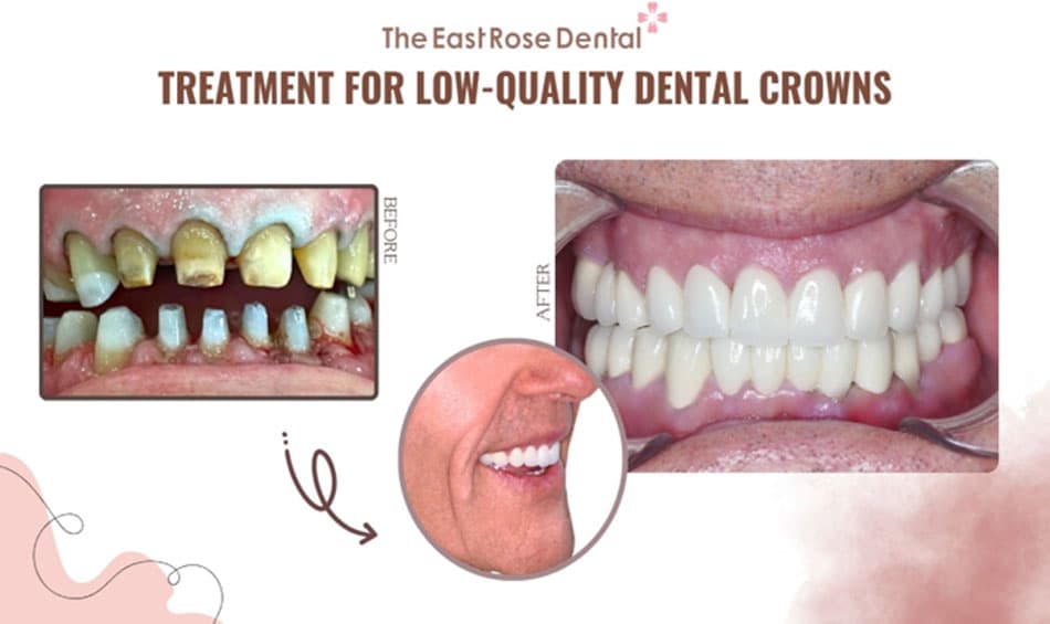 Treatment for cases of low-quality dental crowns