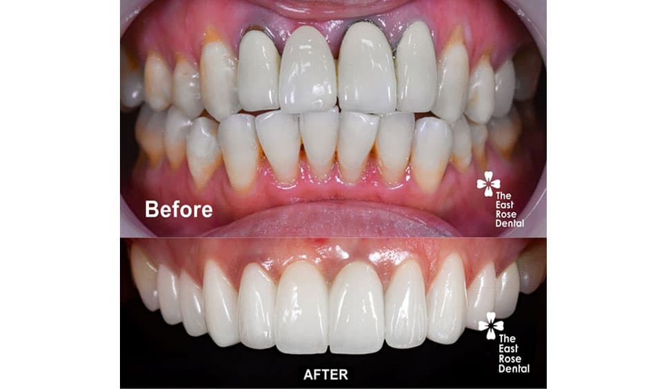 Dark gum lines are a sign that a dental crown needs replacement