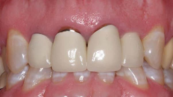 Gaps in dental crowns affect chewing function and aesthetics