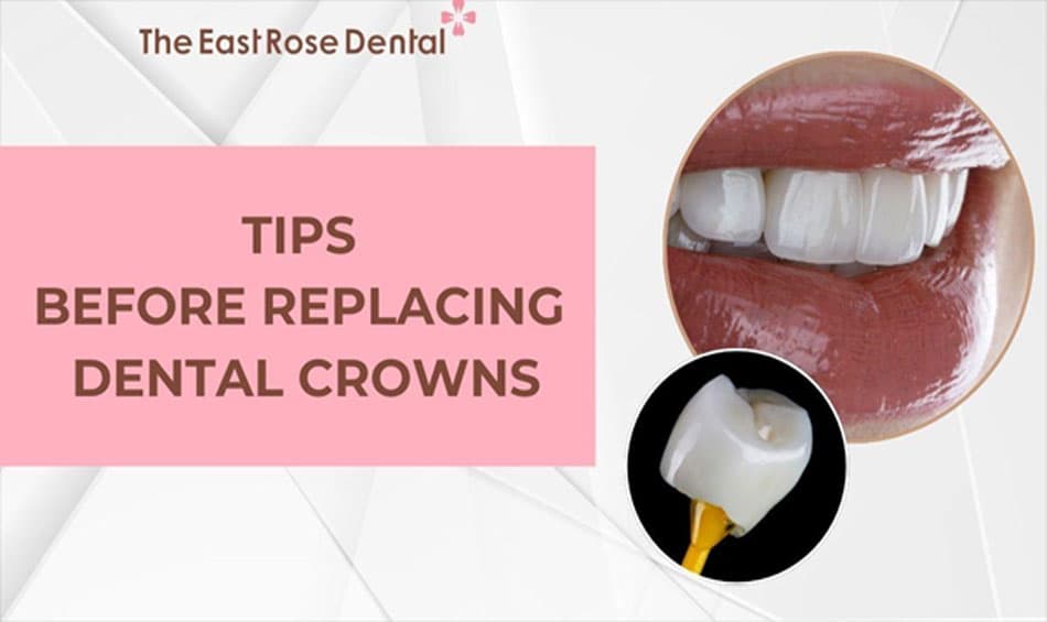 Key considerations when deciding to replace a dental crown