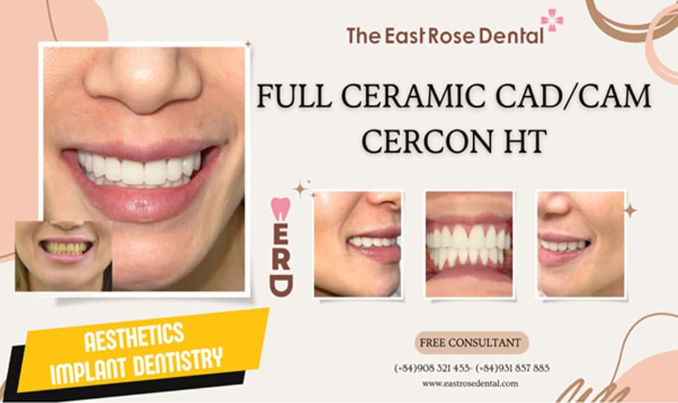 Results of Dental Crown Placement at the East Rose Dental Clinic