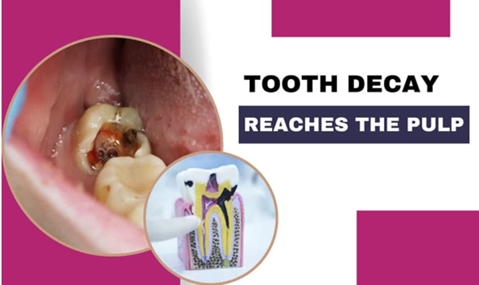 Signs of Deep Tooth Decay into the Pulp and Timely Treatment Methods