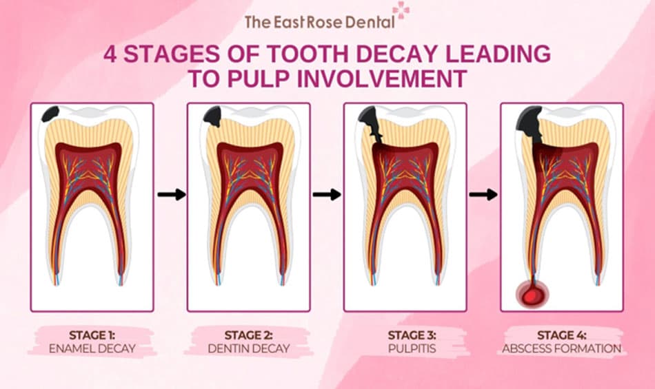 Signs of Tooth Decay Reaching the Pulp at Each Stage