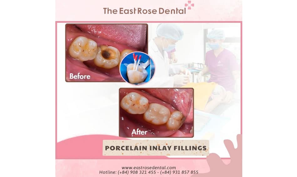 Treatment of tooth decay involving the pulp