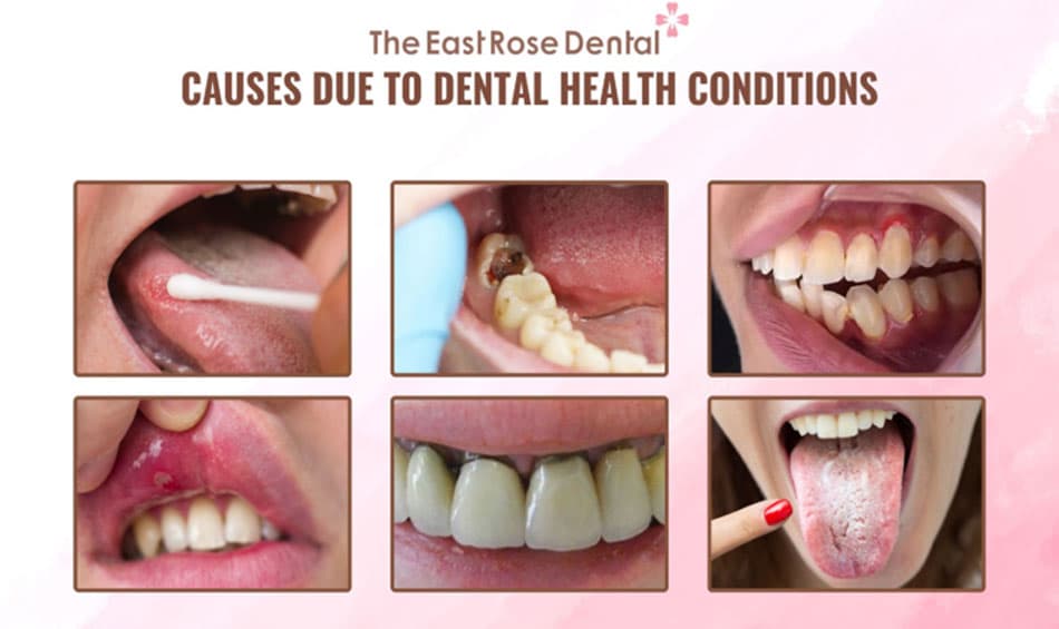 Causes due to dental diseases