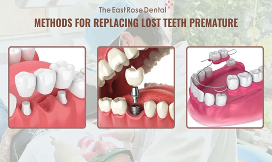 Methods for restoring premature tooth loss