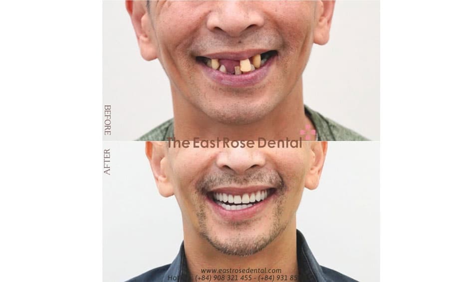 Results of tooth loss treatment at The East Rose Dental Clinic