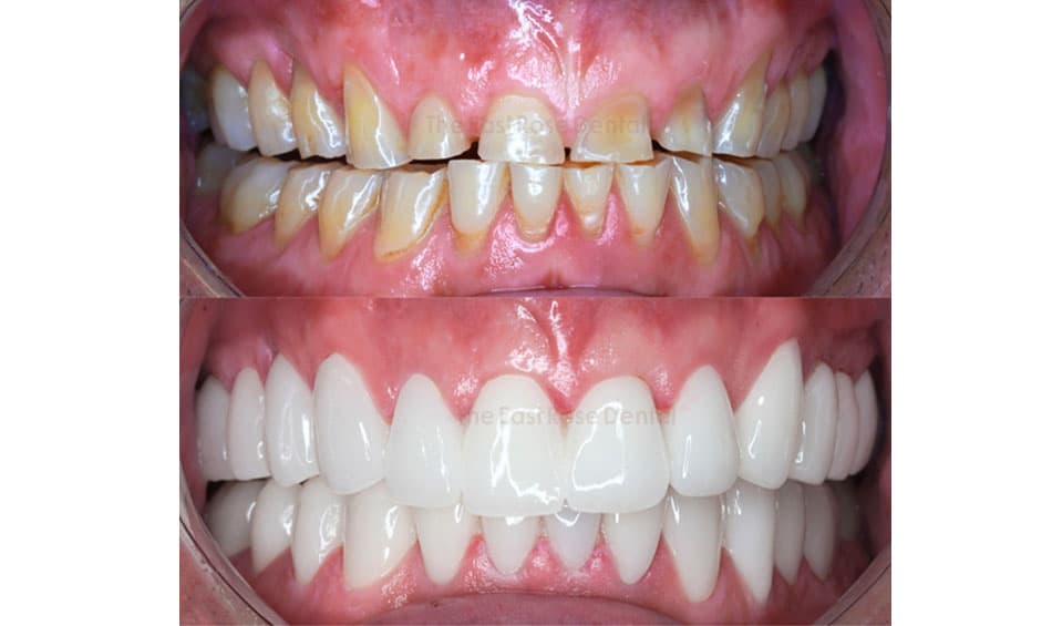 Results of treatment for enamel wear and damage at The East Rose Dental Clinic