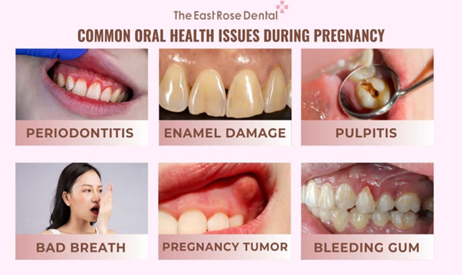 Common dental issues during pregnancy