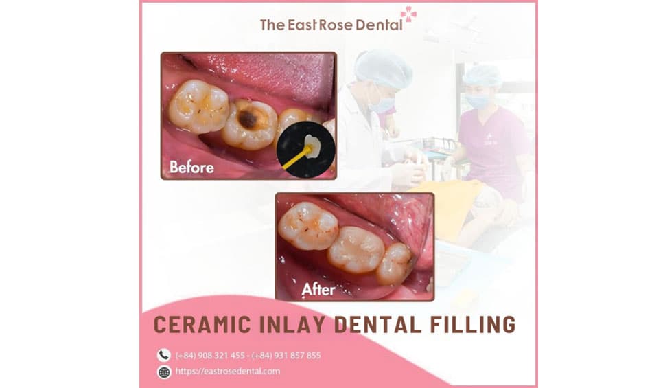 Treatment of tooth pulp inflammation at The East Rose Dental Clinic