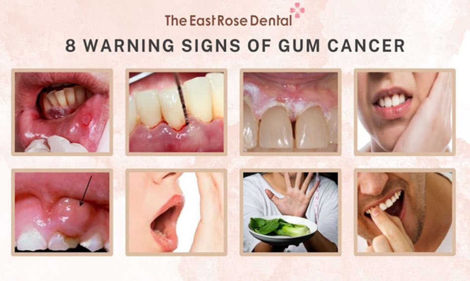 Early warning signs of gum cancer