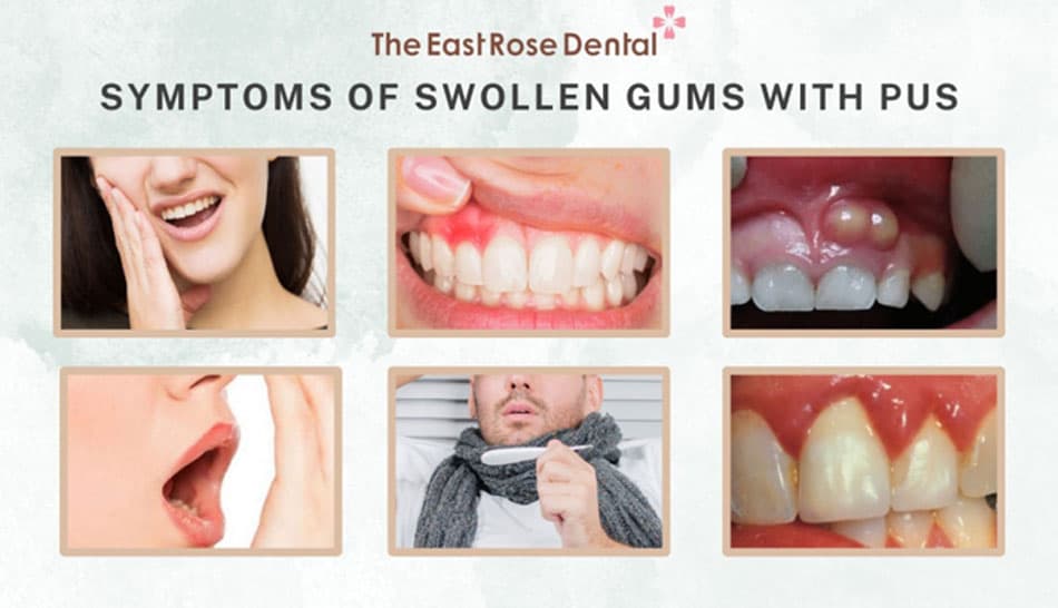 Symptoms of having swollen gums with pus