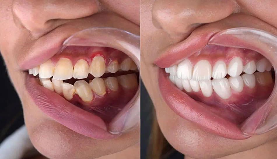 Treatment method for swollen gums with pus