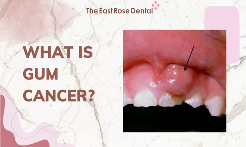 8 Early Symptoms of Gum Cancer and Treatment Methods