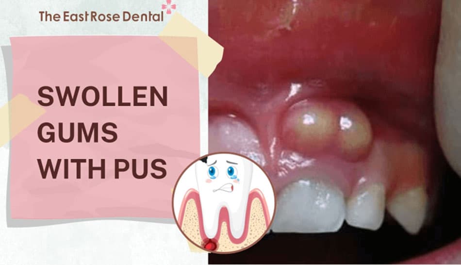 Causes of swollen gums with pus and home remedies