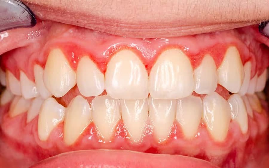 What you need to know about gingivitis