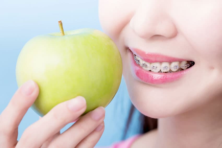 4 things to know before getting braces