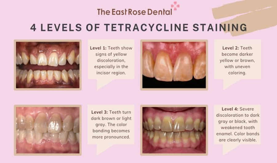 4 Levels of Tetracycline Staining on Teeth