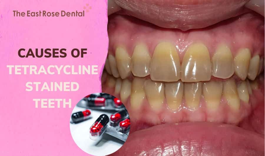 Understanding Tetracycline-Stained Teeth and Effective Treatment Methods