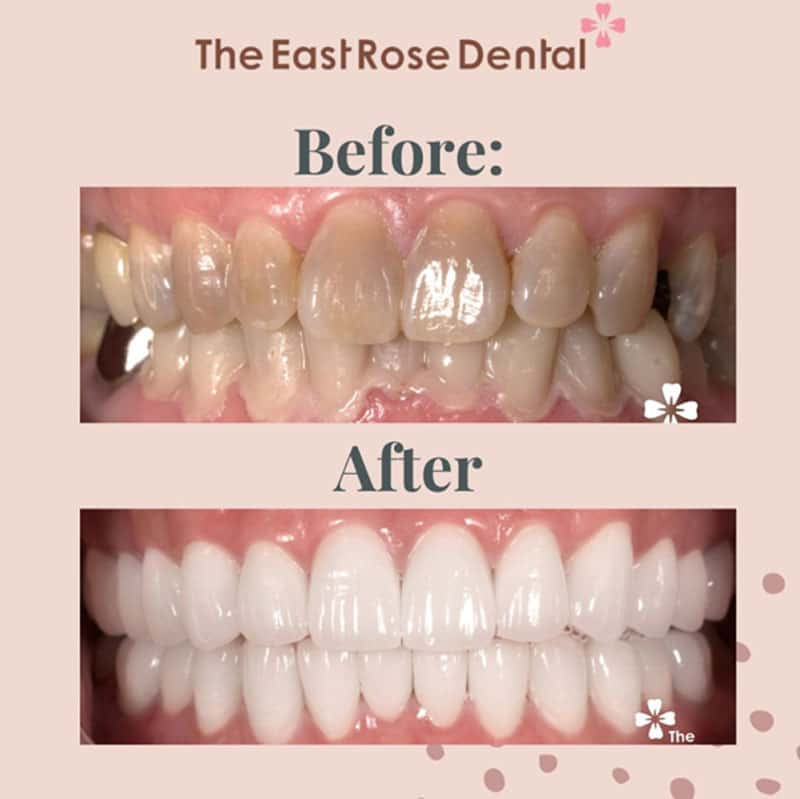 Porcelain Veneers Treatment for Severe Tetracycline Staining