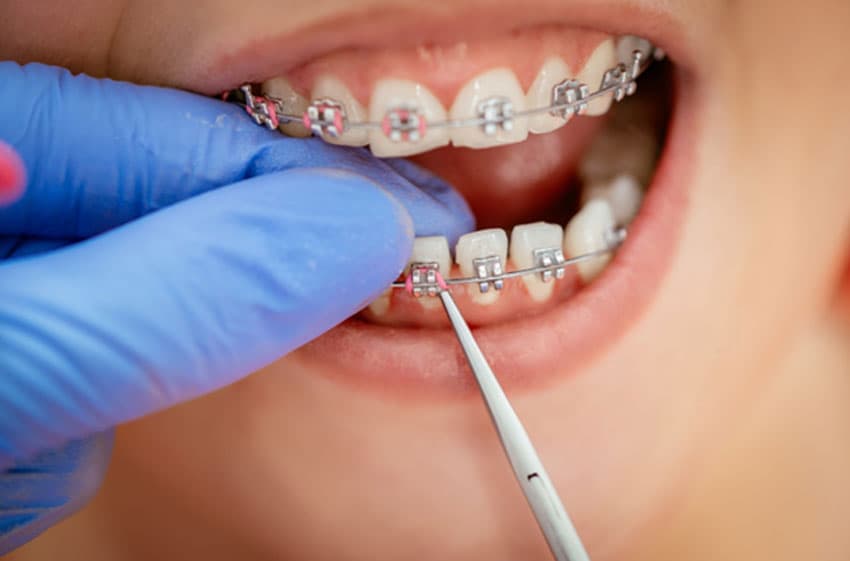 What is teeth tightening with braces? How do it take place?