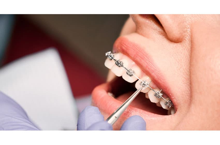 What is teeth tightening with braces? How do it take place?