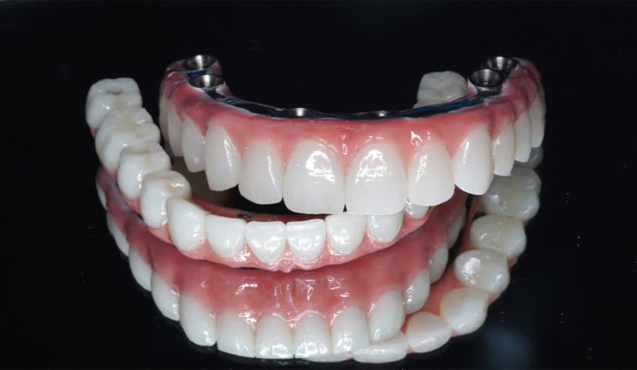 4 Critical Times to Upgrade Your All On X Dental Bridge