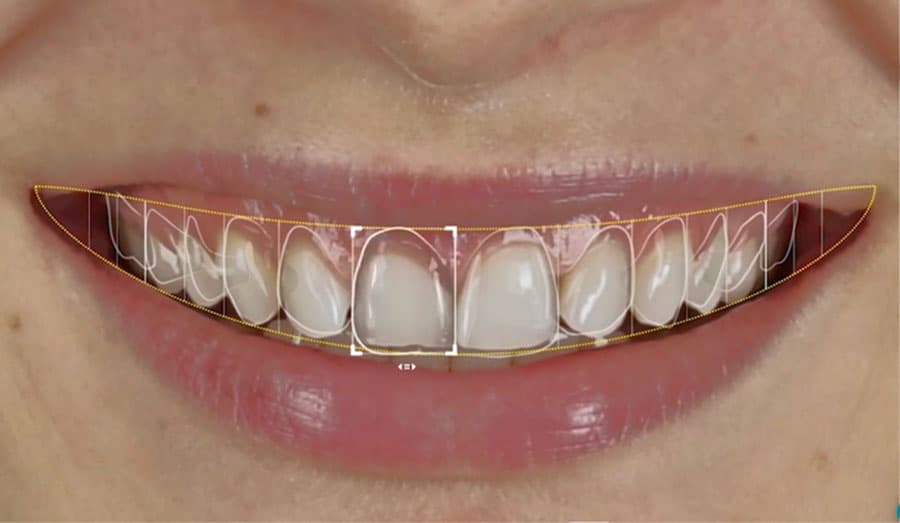 Explore the process of designing smiles using Digital Smile Design technology