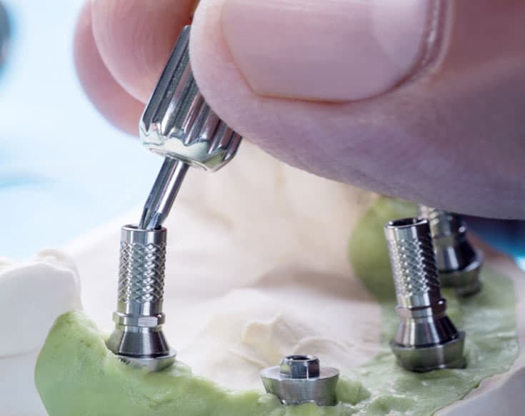 Advantages of Customized Abutment 