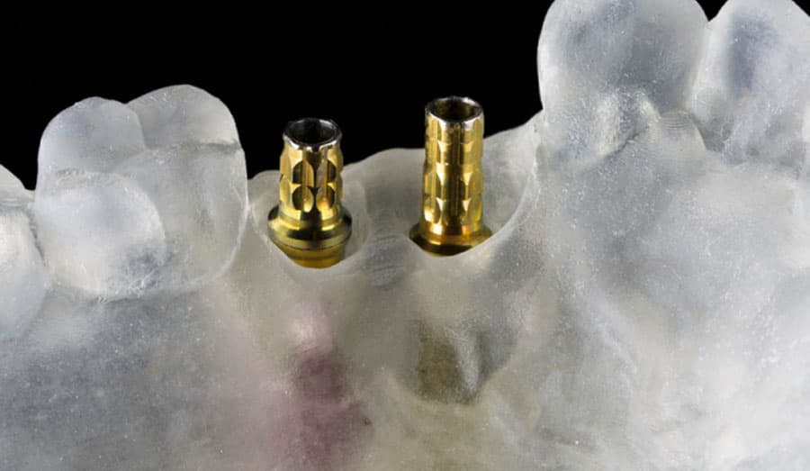 The Difference Between Standard Abutment vs Customized Abutment