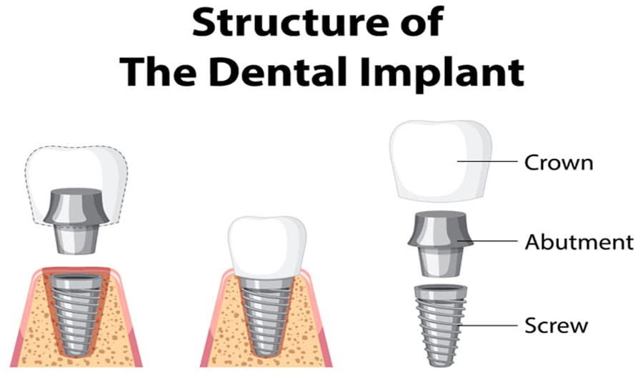 Understanding the role of an Implant Abutment