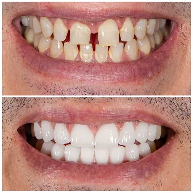 Repair enamel damage by applying porcelain crowns