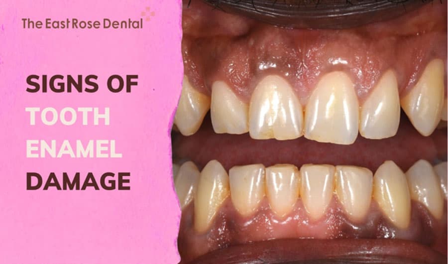 4 Signs of Damaged Tooth Enamel and Effective Remedies