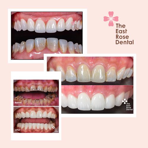 Why do the businessmans choose The East Rose Dental for their Veneers ?
