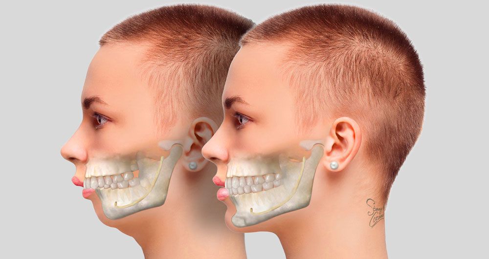 How long does jaw surgery take to heal and stop swelling?