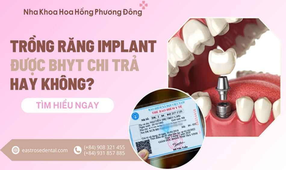 Bảo hiểm y tế cho áp dụng cho dịch vụ trồng răng Implant không?