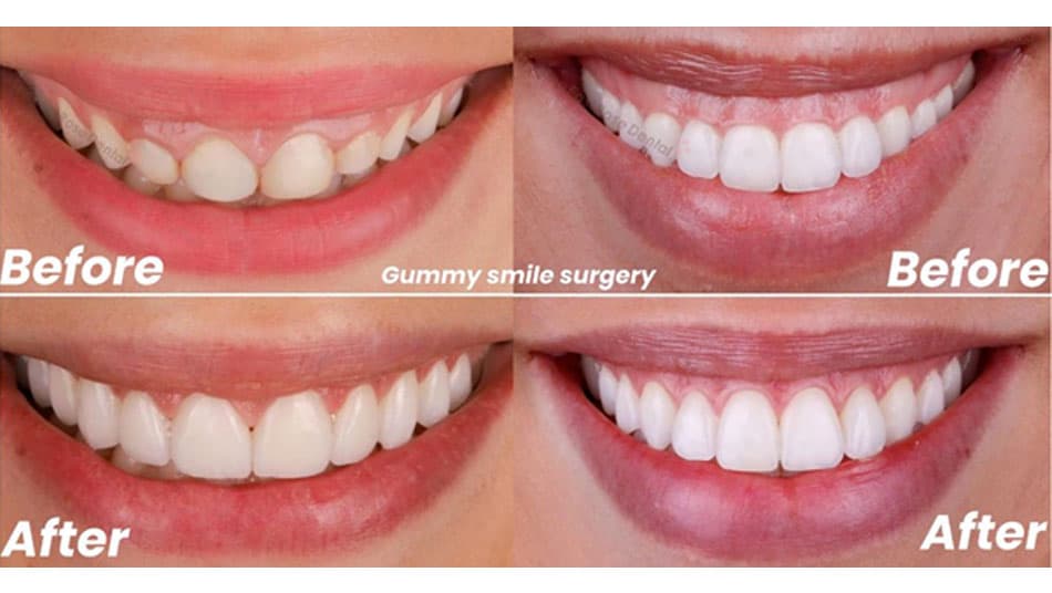 Treatment Results for Crown Lengthening and Gummy Smile Correction With the LX16 Plus Laser