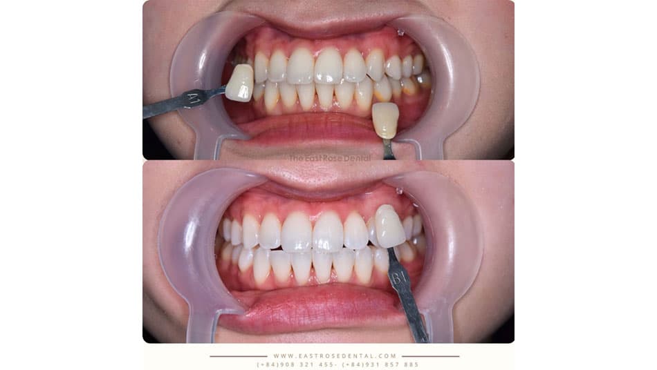 Customers are satisfied with the new technology teeth whitening service