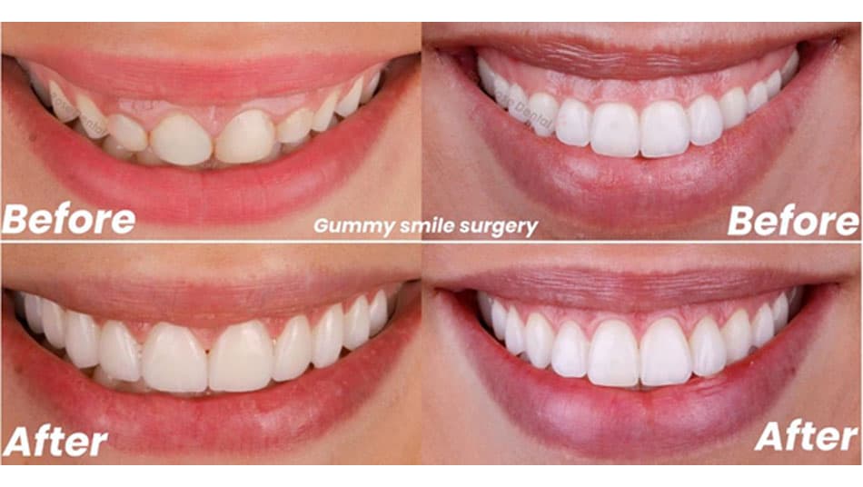 Treatment results of crown lengthening and gummy smile correction using the LX16 Plus Dental Diode Laser