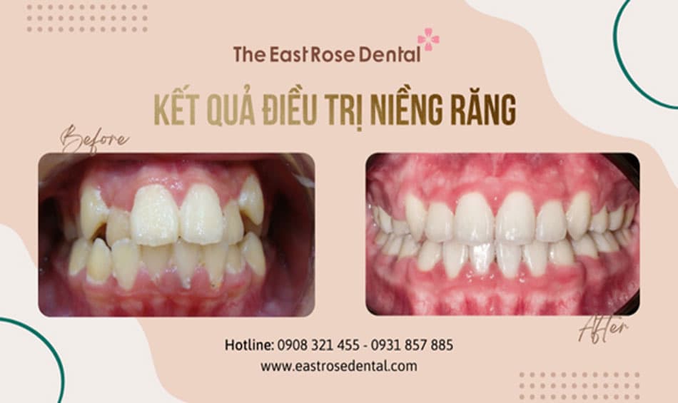 Addressing snaggletooth issues at The East Rose Dental Clinic