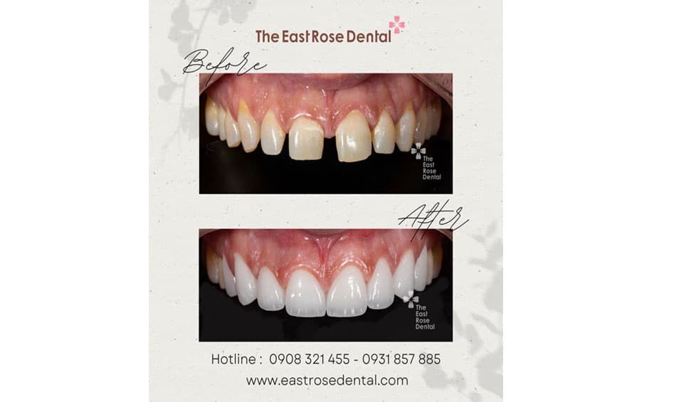 Veneer application method at The East Rose Dental Clinic