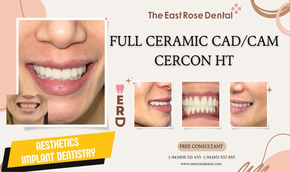 Aesthetic results of Porcelain Crowns at The East Rose Dental Clinic