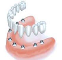 lost all teeth on 1 arch op4