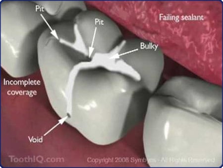 applying sealants