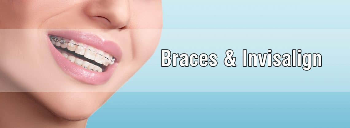 How braces work and the many types of braces?