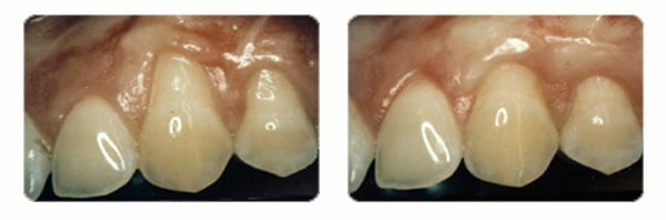 Gum Graft Surgery case 1