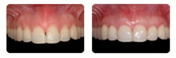 Gum Graft Surgery case 3