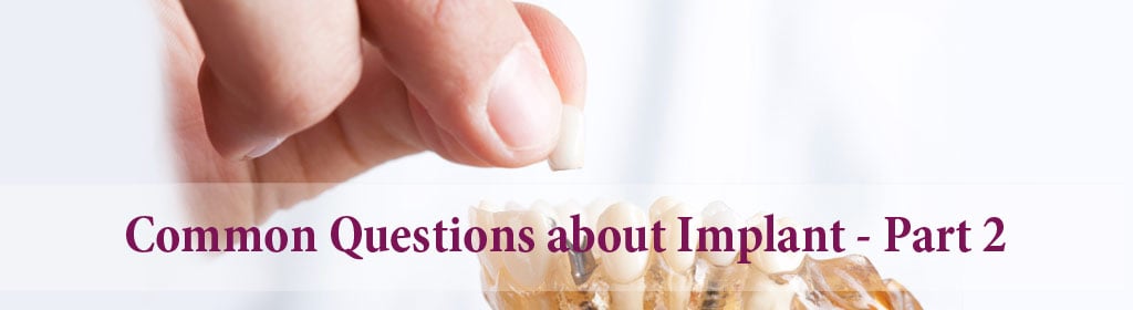  Common Questions about Dental Implant – Part 2